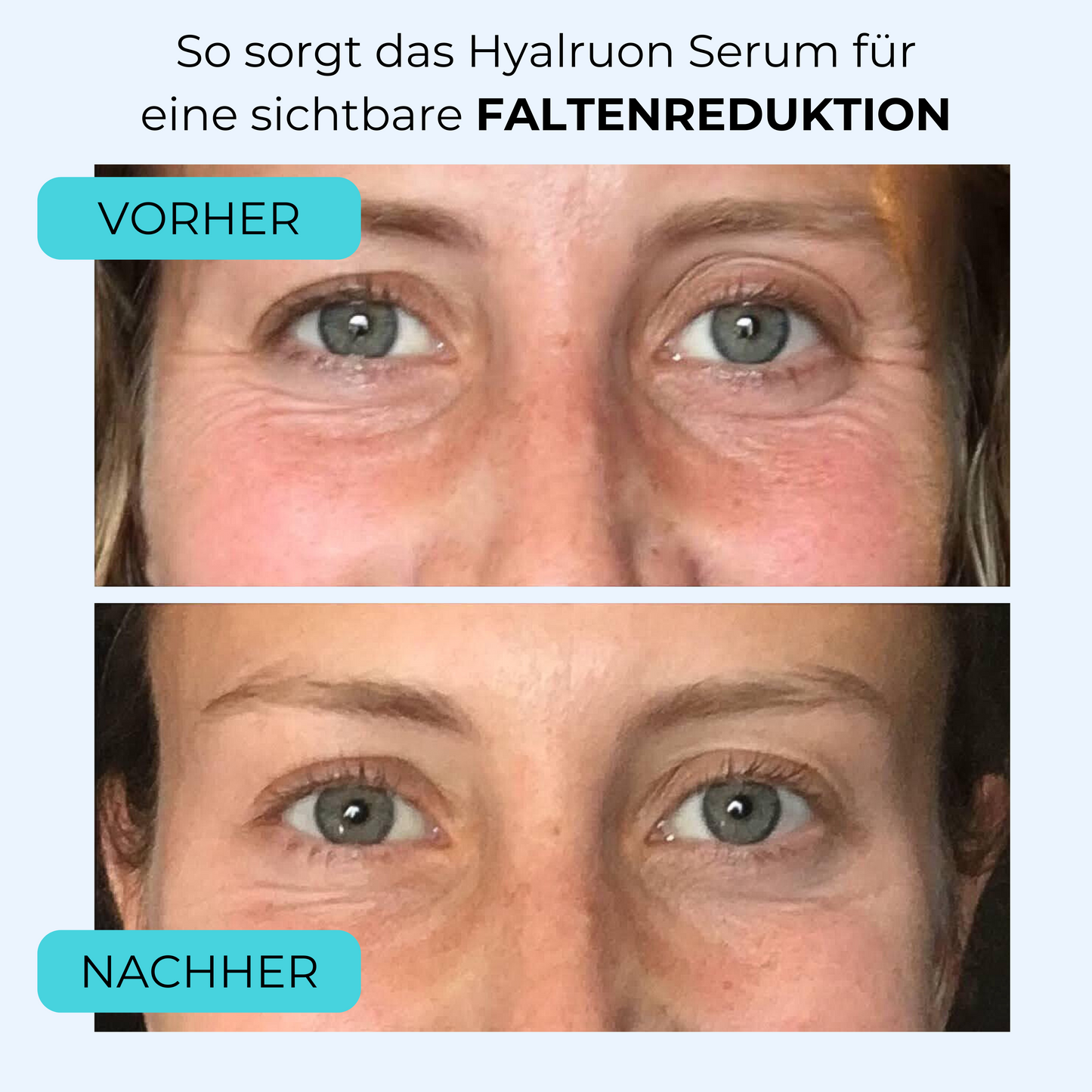 Hyaluron Serum ᐅ Falten aufpolstern & reduzieren