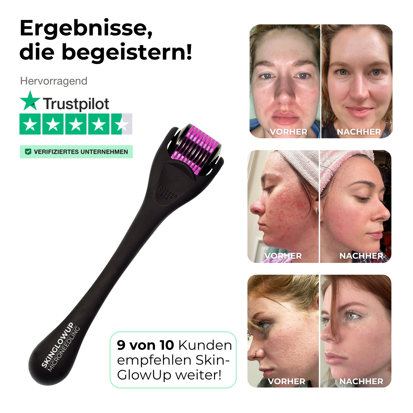 Poren Dermaroller 0,2mm ᐅ Poren verkleinern & strahlender Teint