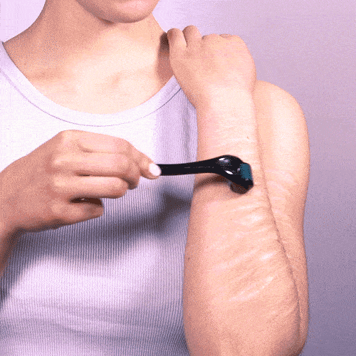 Der 0,5mm Dermaroller von Skinglowup wird gegen Narben am Arm angewendet. Beim Richtungswechsel wird der Derma Roller angehoben.