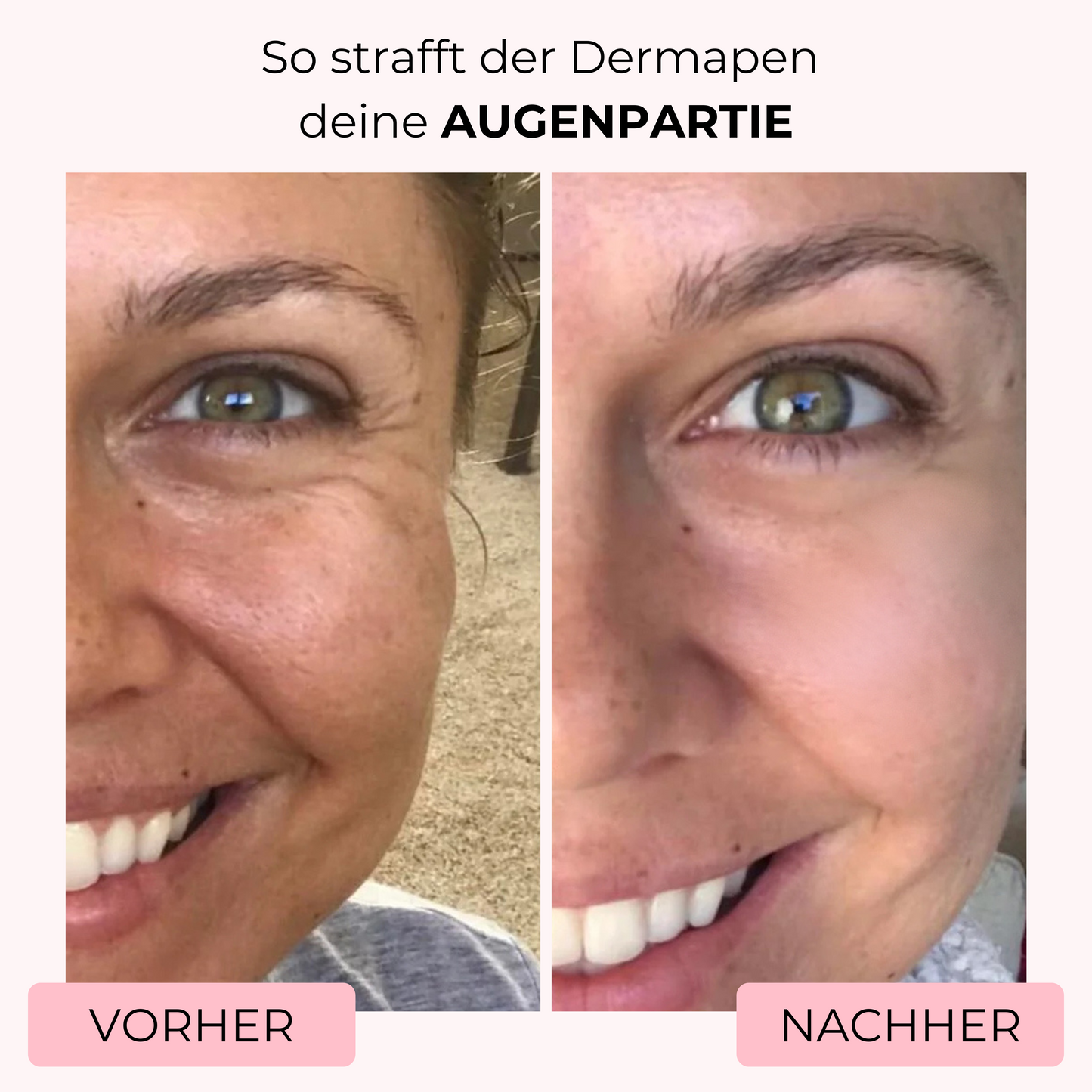 Vorher-Nachher-Bild, das zeigt, wie mit dem Dermapen von SkinGlowUp Falten und Krähenfüße um die Augenpartie sichtbar geglättet wurden. Das Ergebnis der Microneedling-Behandlung zeigt eine straffere und glattere Haut rund um die Augen.