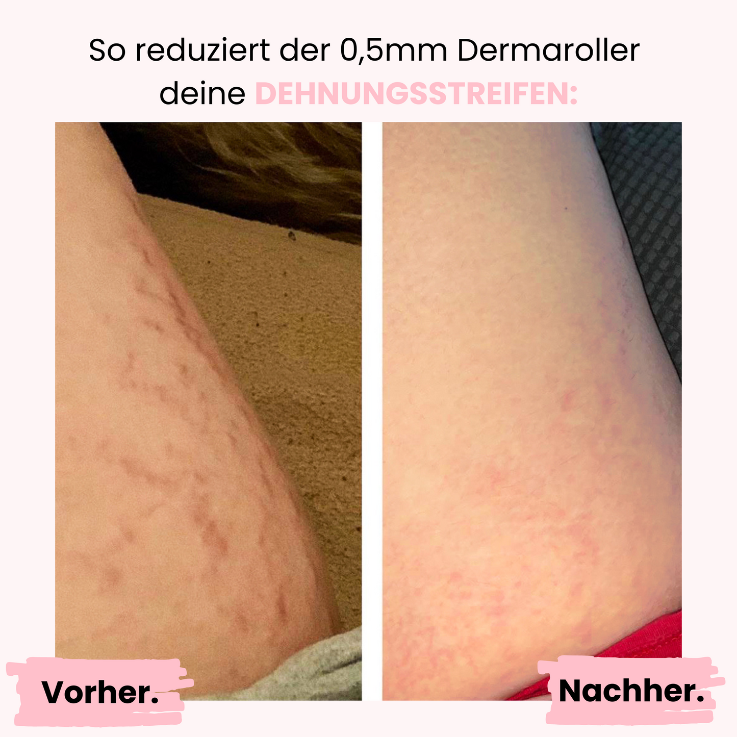 Vorher Nachher Bild Microneedling, durch das Microneedling mit dem Body Dermaroller sind die Dehnungsstreifen auf den Beinen beinahe verschwunden.