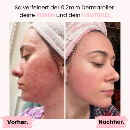 Microneedling Dermaroller Gesicht 0,2mm ᐅ Anti-Aging