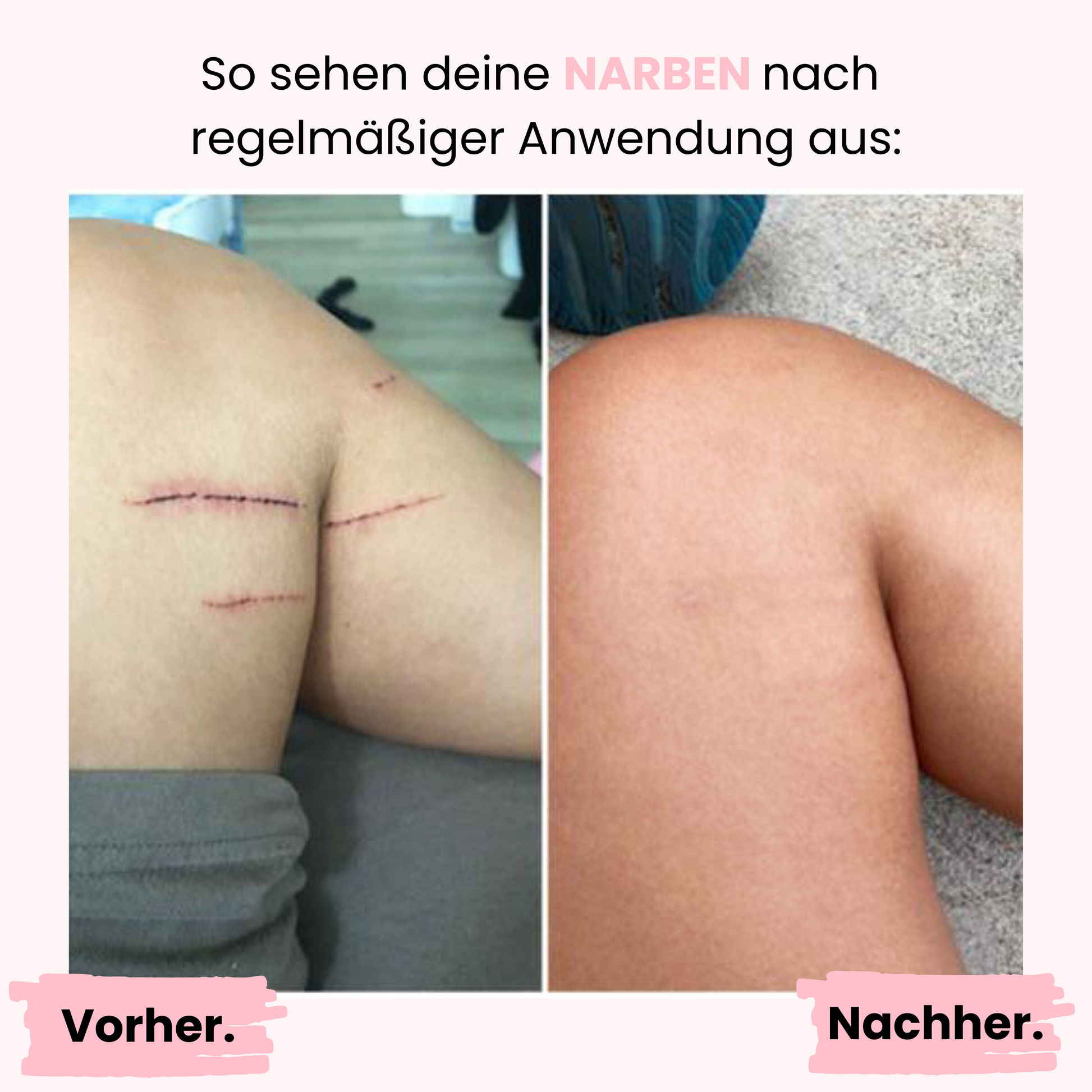 Microneedling vorher / nachher Bild: die Narben an den Beinen einer Kundin sind deutlich reduziert und durch das Micronedling kaum noch sichtbar.