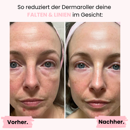 Microneedling Dermaroller Gesicht 0,2mm ᐅ Anti-Aging