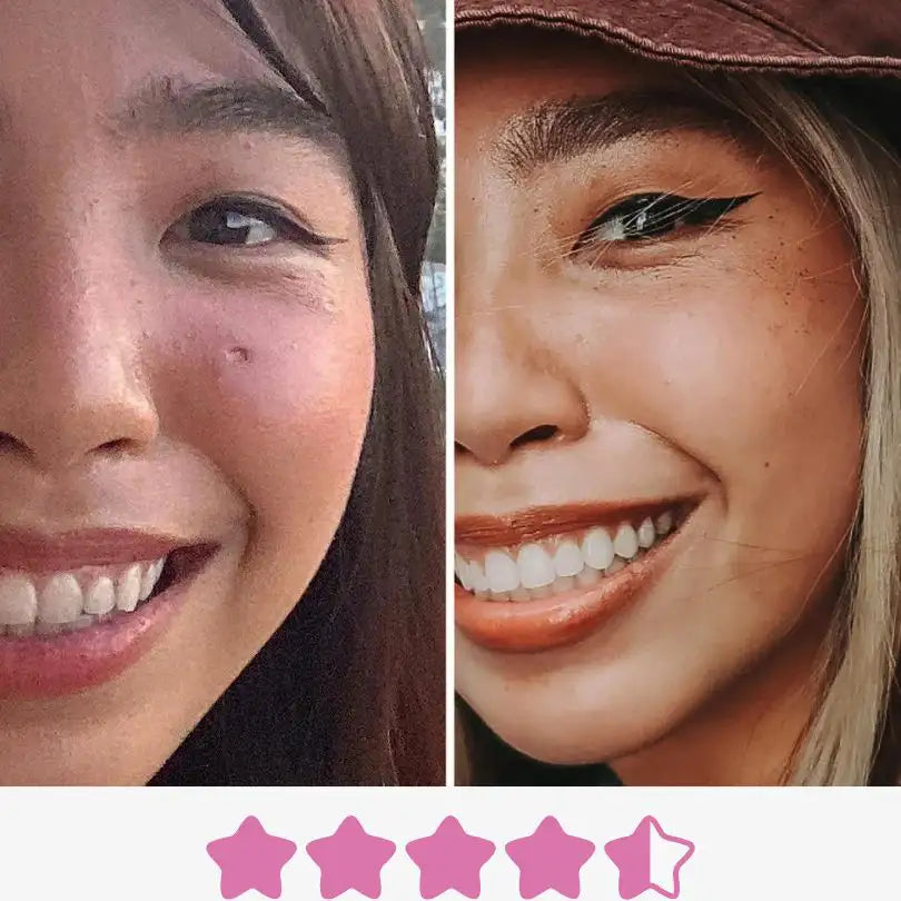Kundenfeedback, Kaya hat durch Microneedling ihre Narbe im Gesicht geglättet 