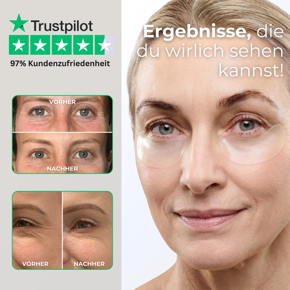 Microneedle Infusion Eye Patches Vorher-Nachher Effekt gegen Augenringe, Tränensäcke und feine Falten