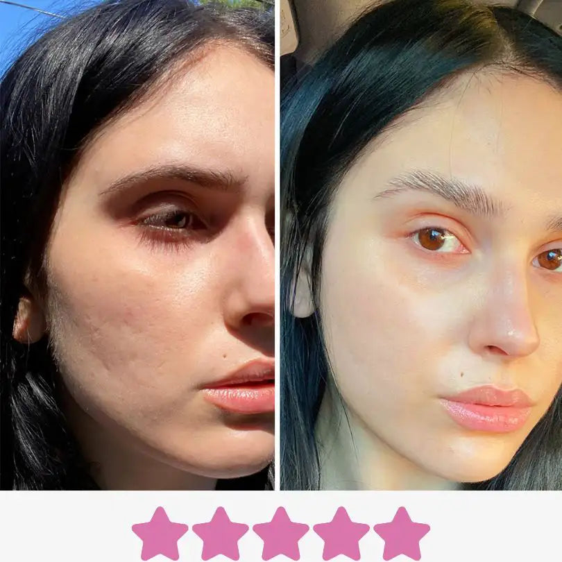 Skinglowup Microneedling Onlineshop Kundenfeedback, Luisa aus Berlin berichtet dass ihre Hautporen durch das Microneedling viel feiner geworden sind