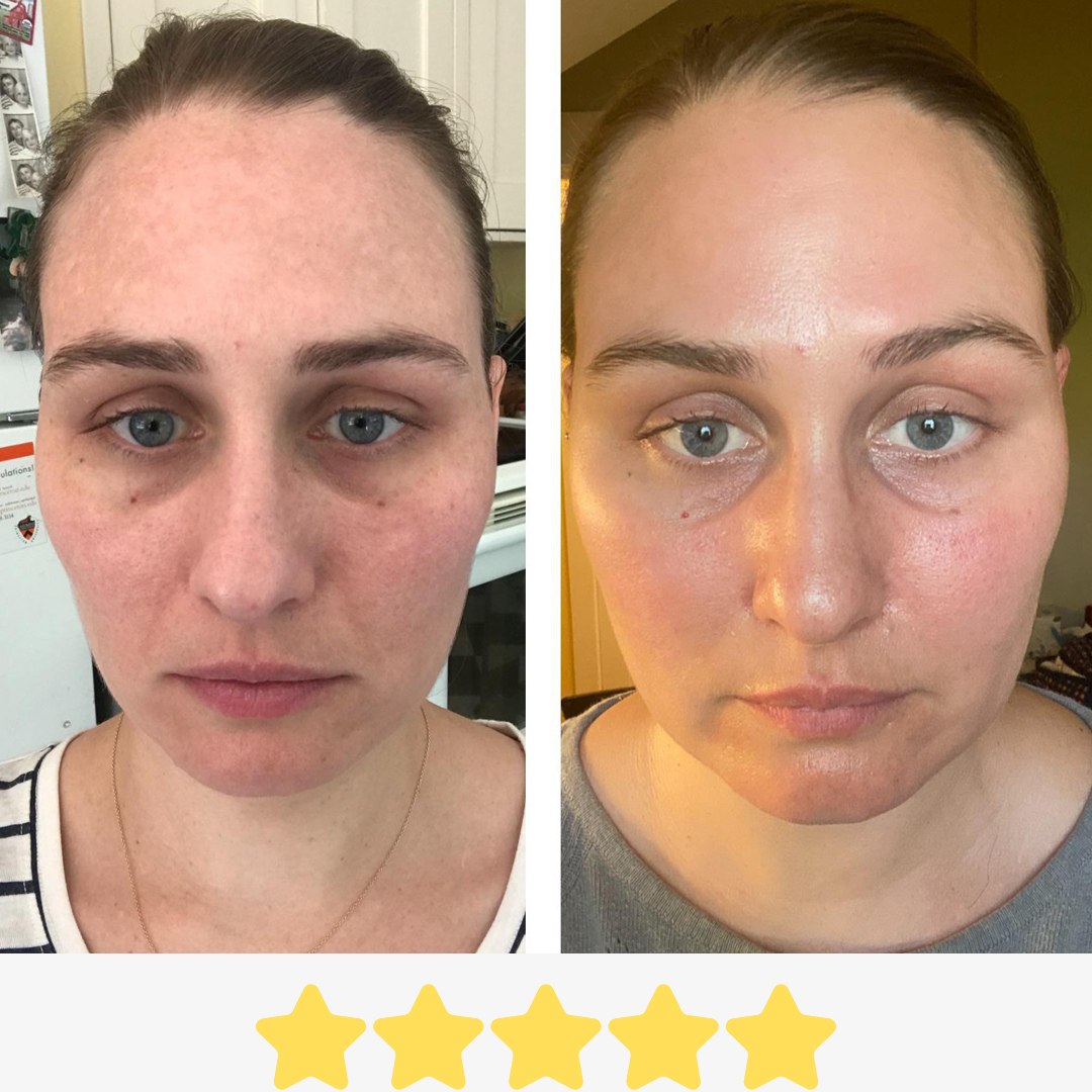 Vorher-Nachher Erfahrung: Sichtbar ausgeglichener Teint und frischeres Hautbild nach regelmäßiger Micro-Anwendung.