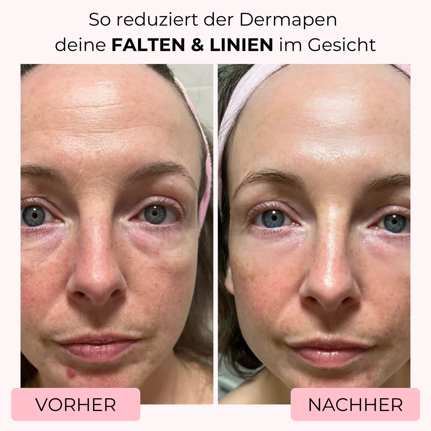 Vorher-Nachher-Bild einer Frau, bei der mit dem Dermapen von SkinGlowUp feine Linien und Falten im Gesicht sichtbar geglättet wurden. Das Ergebnis zeigt eine deutlich straffere Haut und ein jüngeres, glattes Hautbild nach der Microneedling-Behandlung