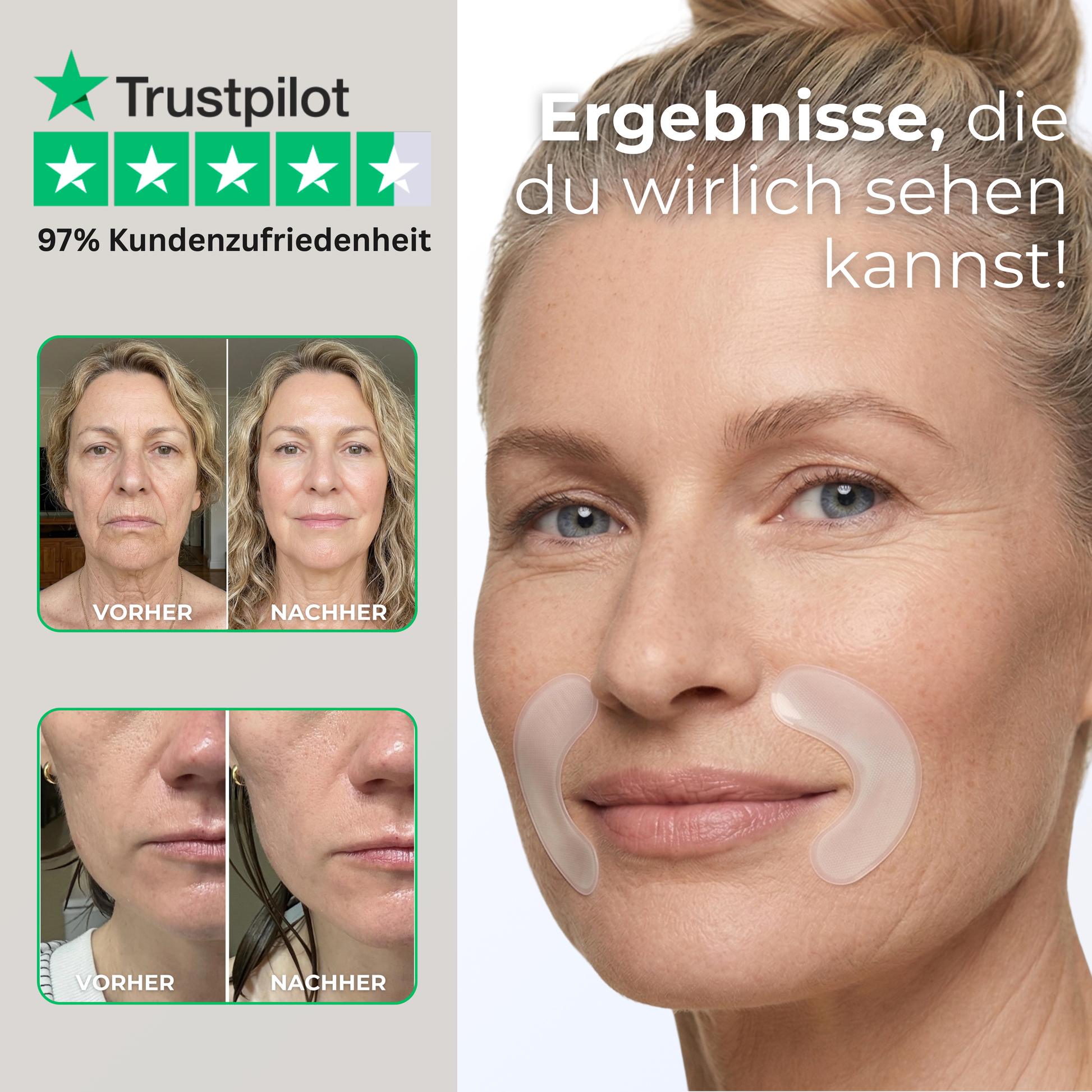 Vorher-Nachher Ergebnisse mit Mundfalten Patches gegen Nasolabialfalten und Fältchen im Mundbereich
