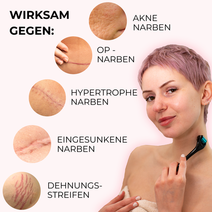 Narbenroller, Microneedling gegen Akne Narben (Eispickel und Boxcar), Chirugische OP Narben, hypertrophe Narben, athrophe Narben, Dehnungsstreifen und Schwangerstreifen.