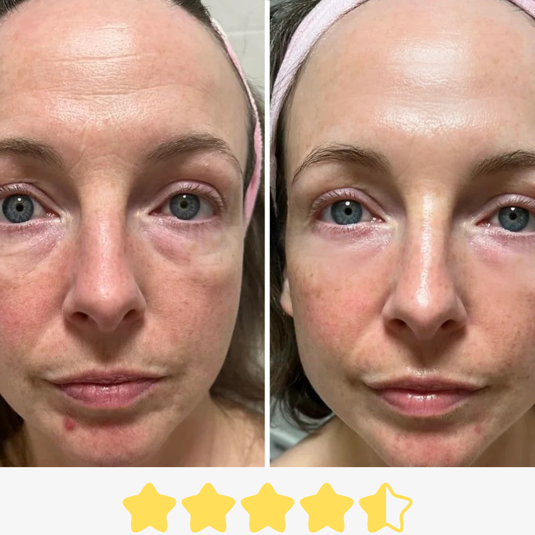 Ergebniss: Straffung von Falten und feinen Linien um die Augenpartie mit Dermapen Microneedling