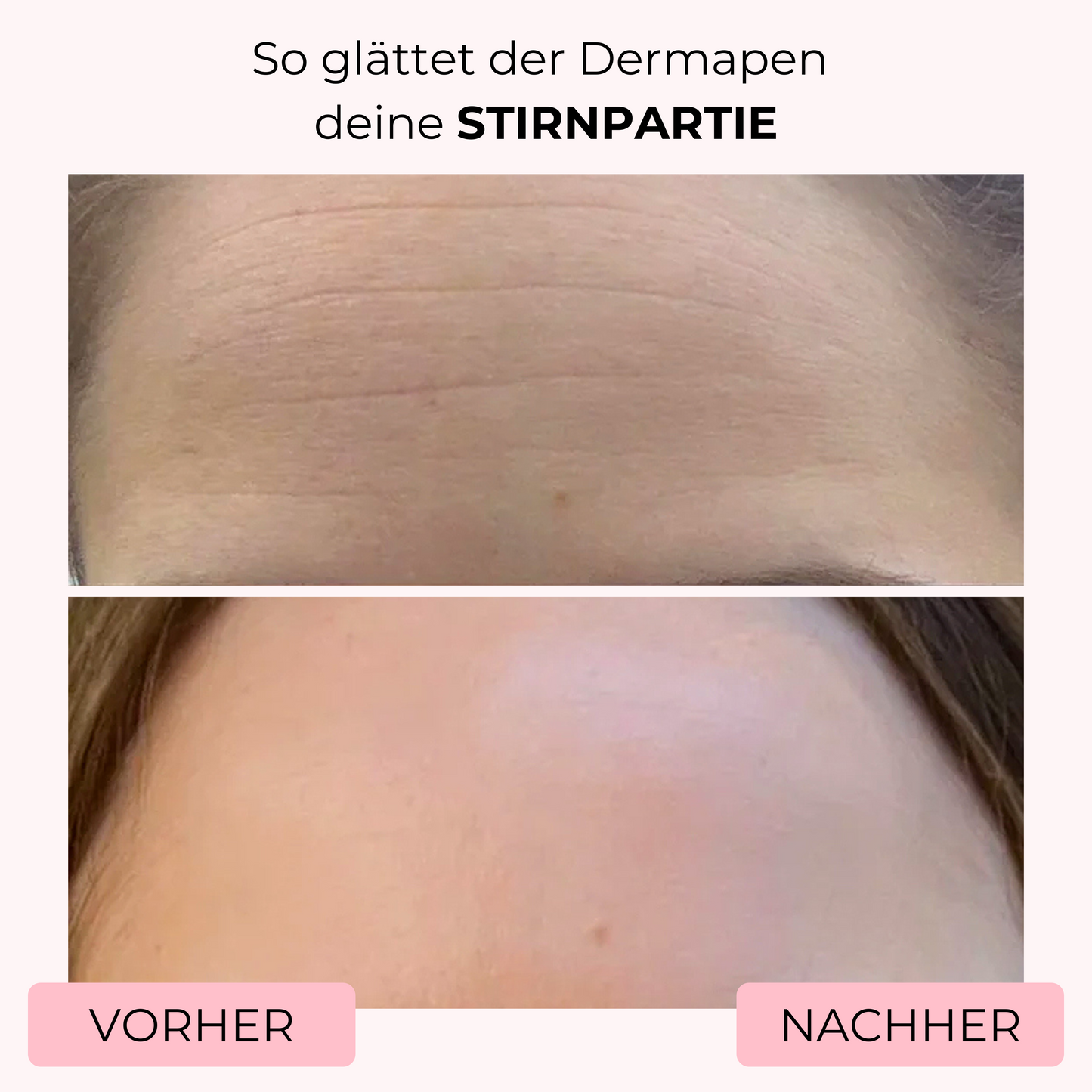 Vorher-Nachher-Bild einer Frau, bei der mit dem Dermapen von SkinGlowUp tiefe Stirnfalten sichtbar geglättet wurden. Die Microneedling-Behandlung zeigt eine deutlich straffere und glattere Haut auf der Stirn nach der Anwendung.